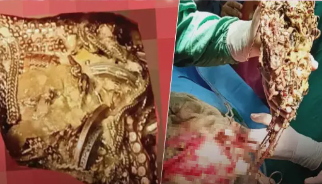 Hepsi midesinden çıktı doktorlar şoke oldu! Milyonlarca lira değerinde..